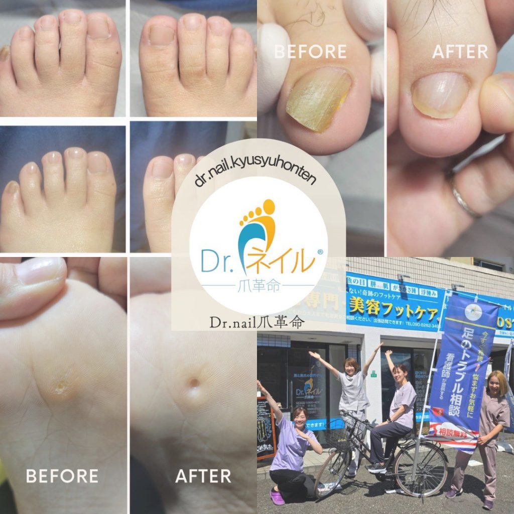 【ドクターネイル爪革命】　九州本店　優しいフットケア